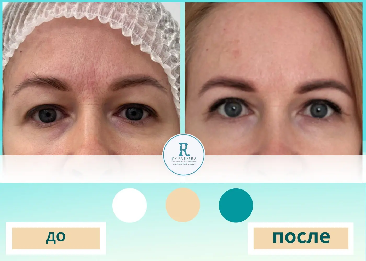 Блефаропластика результаты (2)
