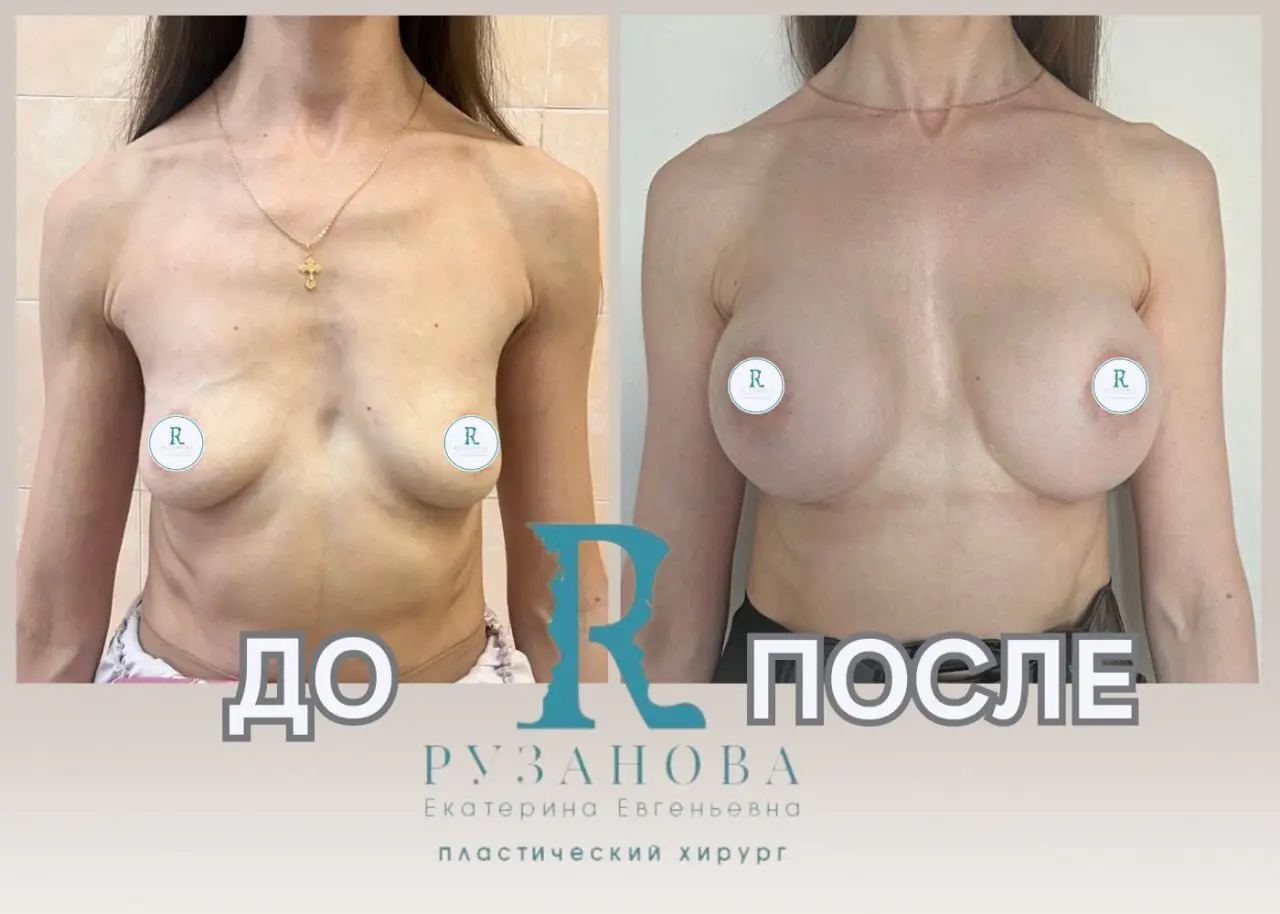 Результаты по пластике груди (2)