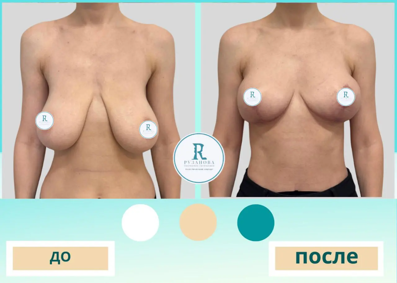 Результаты по пластике груди (3)