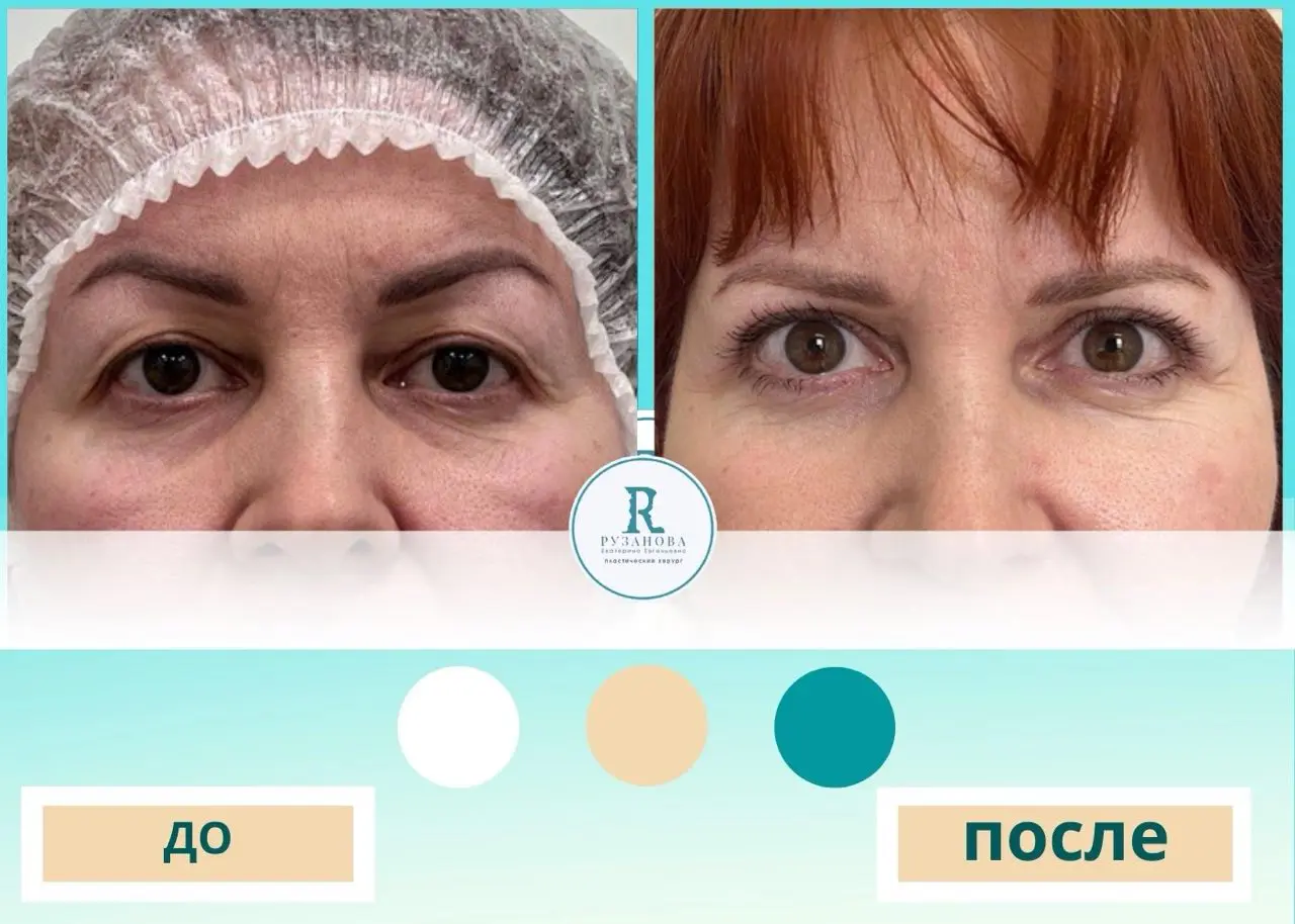 Результаты по пластике шеи (1)