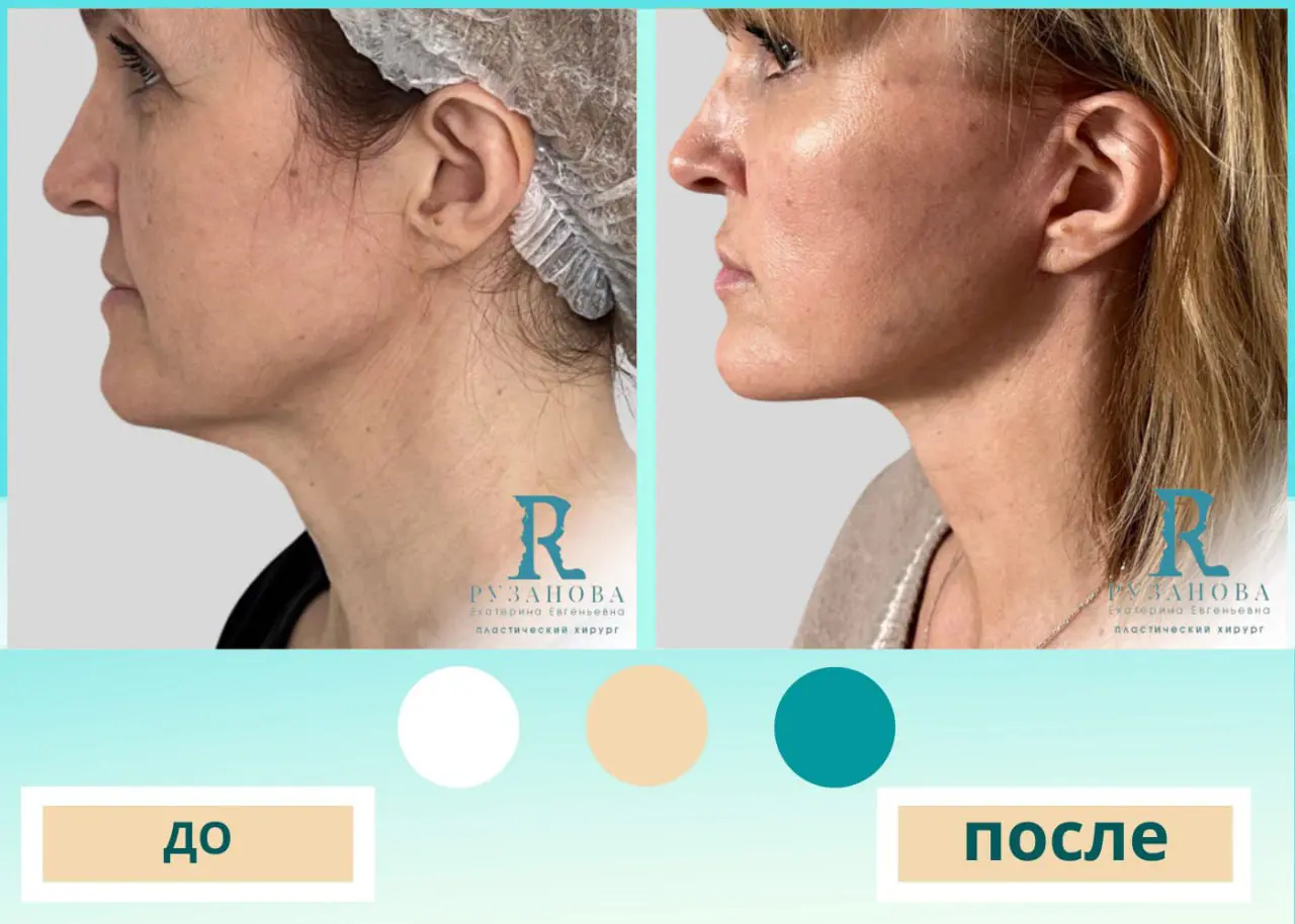Результаты по пластике шеи (2)