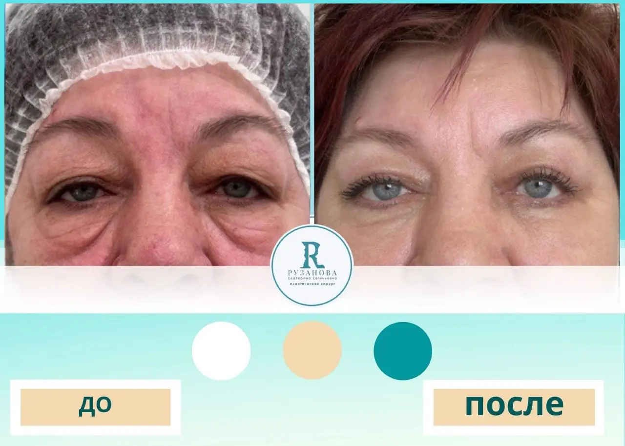 Результаты по пластике шеи (2)