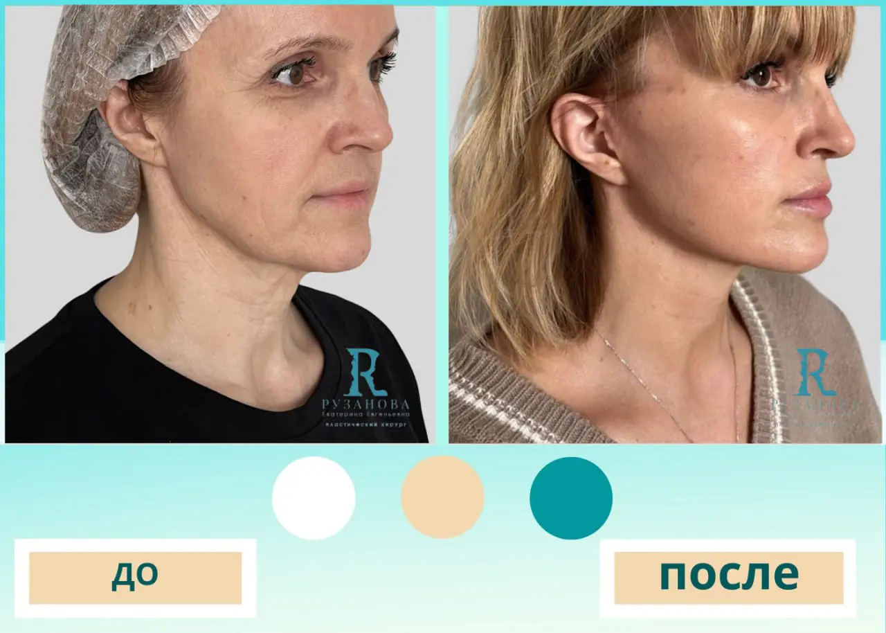 Результаты по пластике шеи (3)
